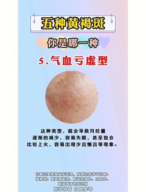 脸上成片黄褐斑能擦粉底液吗_黄褐斑擦粉底遮盖技巧与防晒建议 脸上成片黄褐斑能擦粉底液吗_黄褐斑擦粉底遮盖技巧与防晒建议